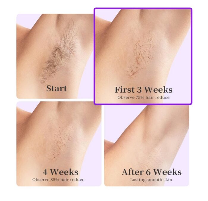 ⁦جهاز إزالة الشعر Hikyskin IPL – تبريد ثلجي، 9 مستويات طاقة، ضربات بلا حدود إزالة شعر سريع وآمن⁩ - الصورة ⁦2⁩